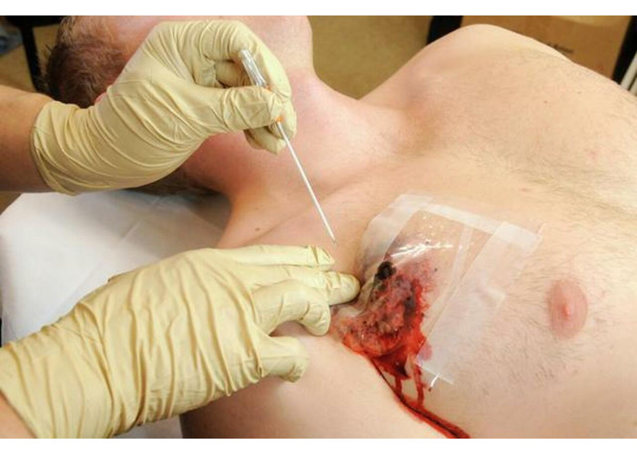 Голка для декомпресії при пневмотораксі TyTek Medical TPAK