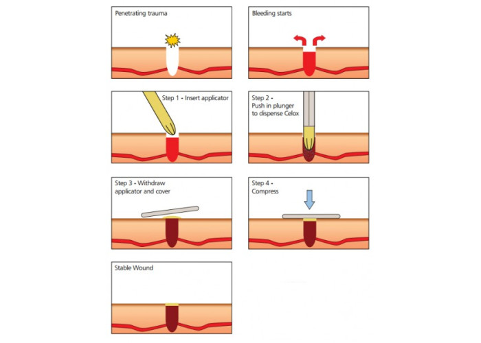 Кровоспинний аплікатор Celox-A